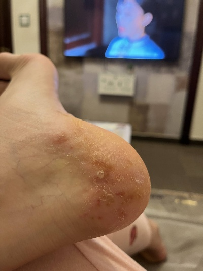脚上起小水泡还很痒？别忽视，这几种常见原因在作怪